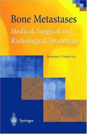 Bone metastases：medical, surgical, and radiological treatment