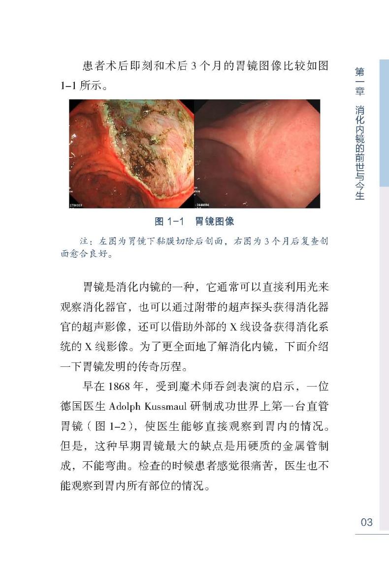 早期消化道癌和消化内镜的那些事儿